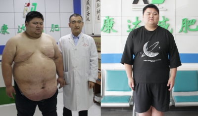 长春康达减肥医院：重450斤男子5个月减去141斤2.jpg